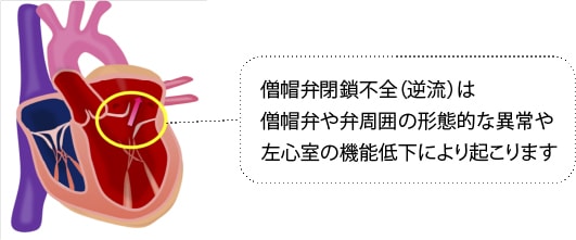 僧帽弁閉鎖不全（逆流）は僧帽弁や弁周囲の形態的な異常や左心室の機能低下により起こります